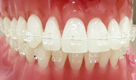 治療の流れ 治療の流れ